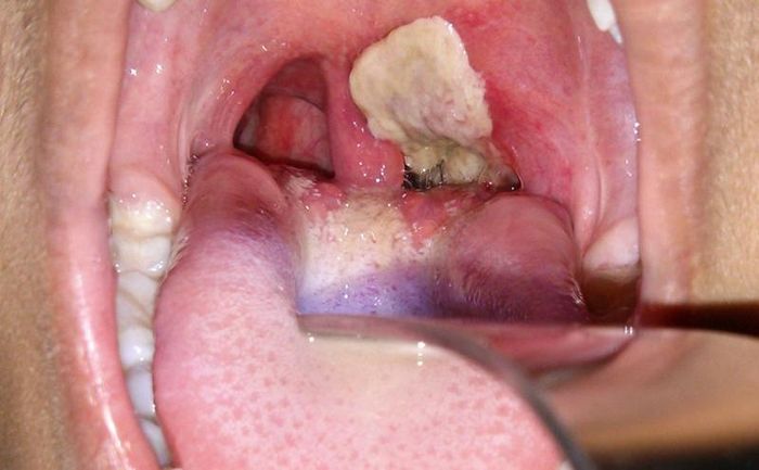Một trong những triệu chứng của bệnh bạch hầu là xuất hiện giả mạc tại vùng hầu họng.